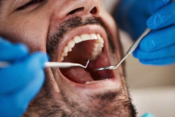 Best Dentist for Tooth Abscess  in Fountainebleau, FL
