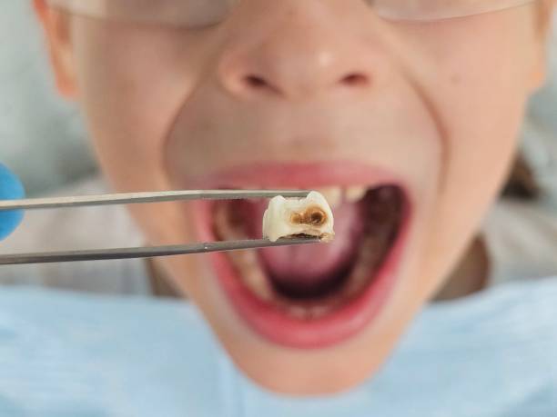Best Knocked-Out Tooth Emergency  in Fountainebleau, FL